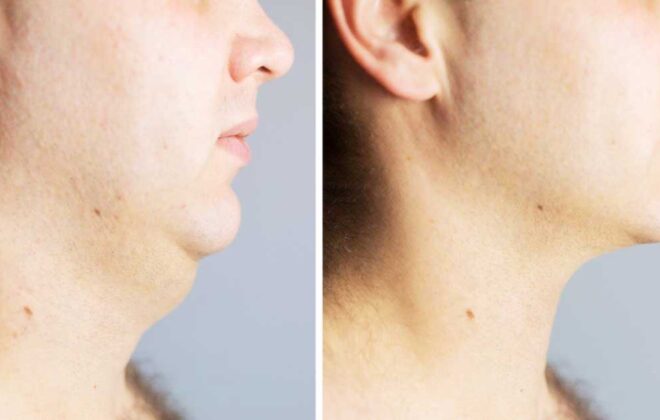 chin lipo before and after