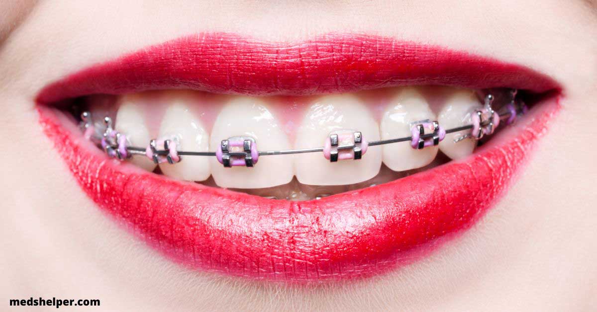 Should You Get Purple Braces On Teeth Meds Helper 