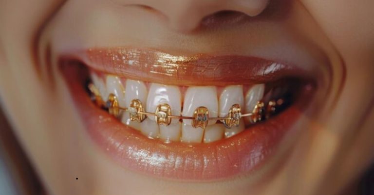 rose gold braces